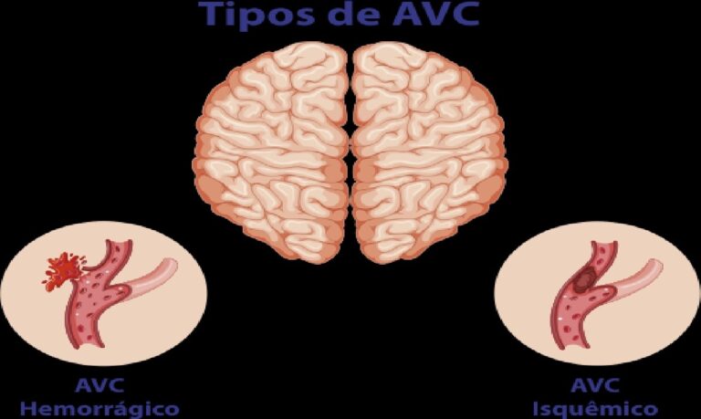 AVC está relacionado a condições como hipertensão, diabetes e colesterol elevado