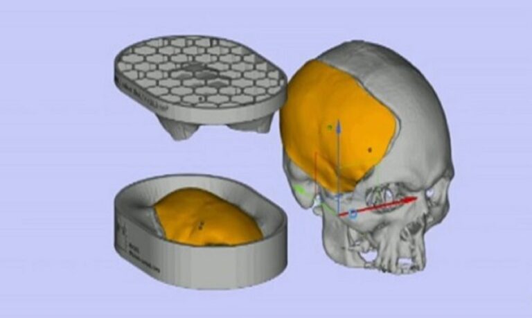 A cranioplastia é uma cirurgia primariamente reparadora para recuperar a função protetora do crânio e tratar a síndrome do trefinado