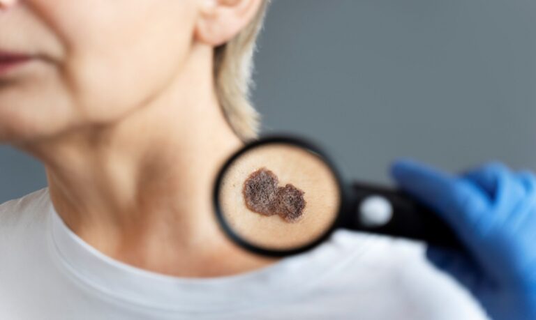 O câncer mais comum na população geral e pode se manifestar em diferentes tipos, como o carcinoma espinocelular, o carcinoma basocelular e o melanoma